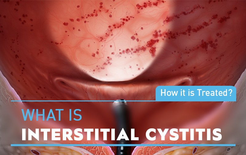 Interstitial Cystisis