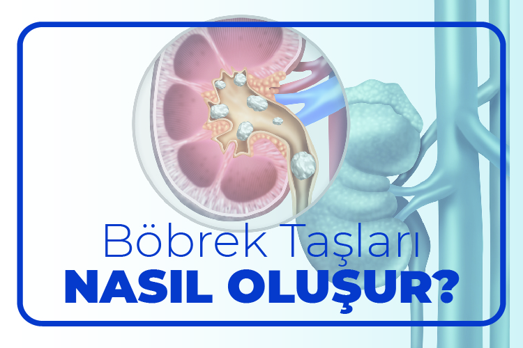 Böbrek Taşları Nasıl Oluşur