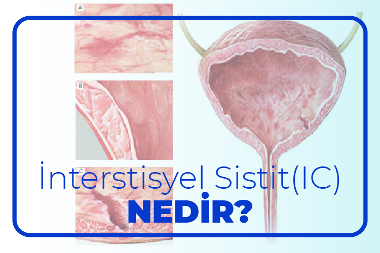 İnterstisyel Sistit Nedir?